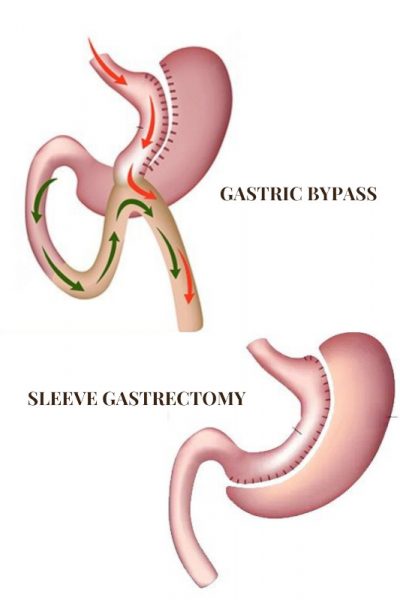 Photo Bariatric 3